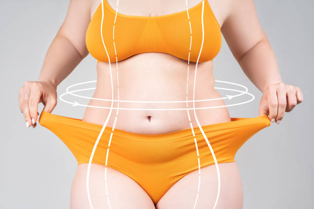 Liposuction Nedir? Hakkında Bilmeniz Gerekenler